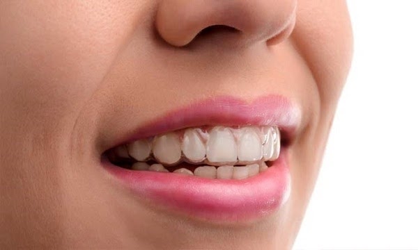 Những điều cần biết về niềng răng trong suốt