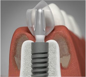 Đặt implant tức thì sau khi nhổ răng