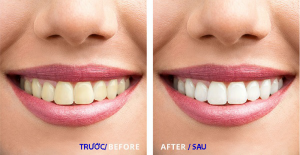 Teeth whitening help you have a bright smileTeeth whitening help you have a bright smile