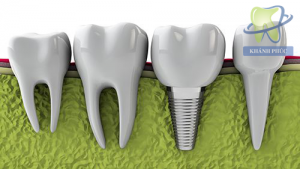 Why is dental implant surgery so wonderful like that?