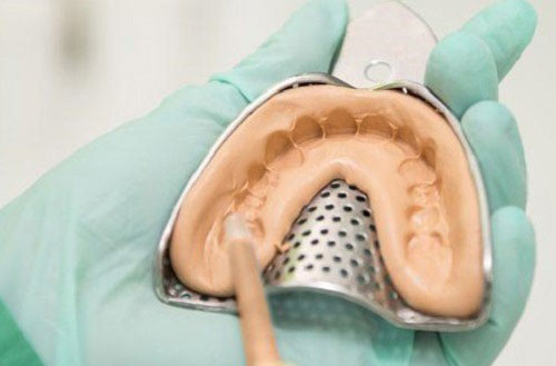 Bạn biết gì về khí cụ trong niềng răng chỉnh nha? - Lấy dấu răng