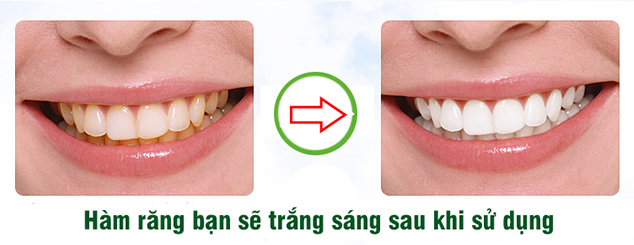 Làm sao để tẩy trắng răng nhiễm màu tại nhà?