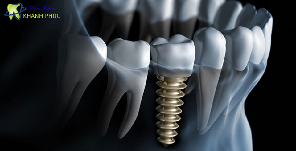 Hệ thống Implant cao cấp
