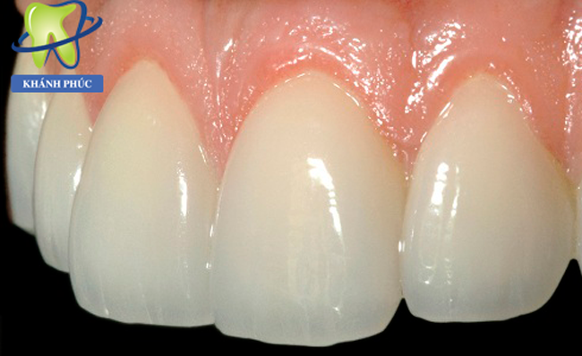 Răng sứ không kim loại là lựa chọn tuyệt vời cho vùng răng thẩm mỹ