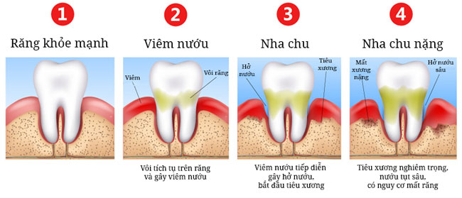Chảy máu chân răng liệu có phải là dấu hiệu bình thường?