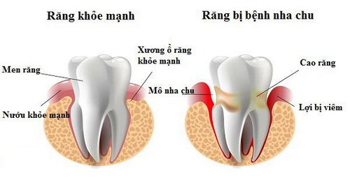 Sự khác biệt giữa răng khỏe mạnh và răng bị viêm nha chu