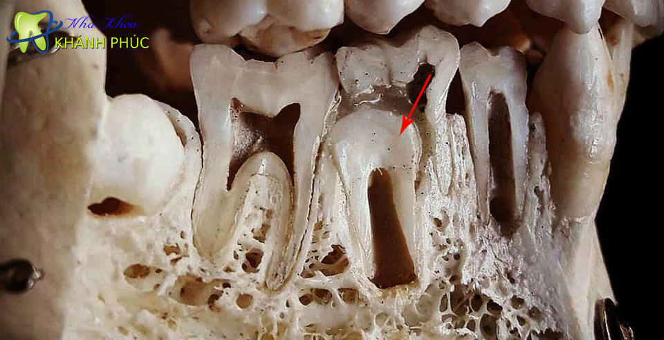 Răng mọc ngầm có tác hại hay không?