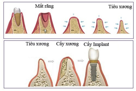 Tiêu xương hàm được khắc phục bằng cấy ghép xương