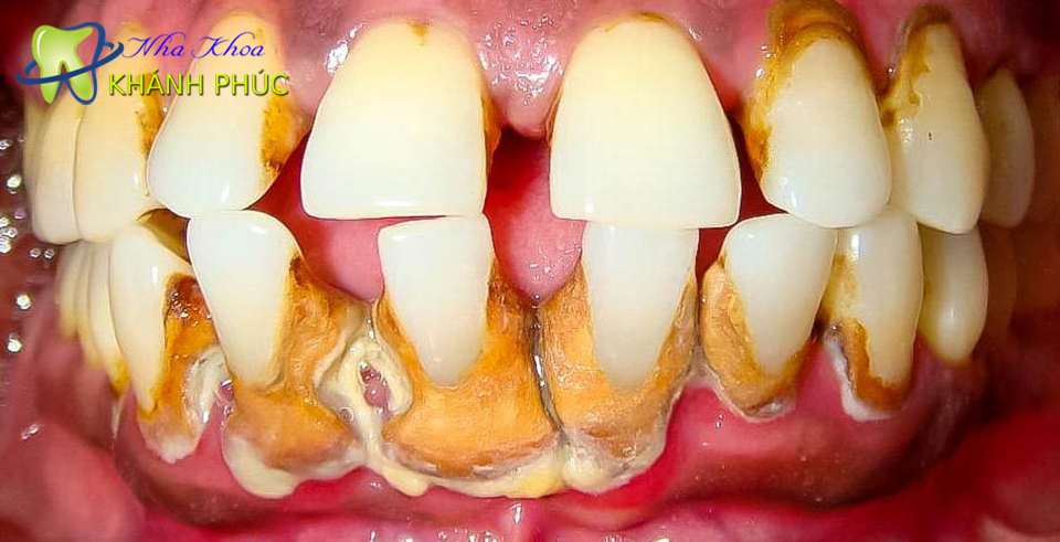 Loại bỏ vôi răng ở đâu không đau và ít ê buốt?