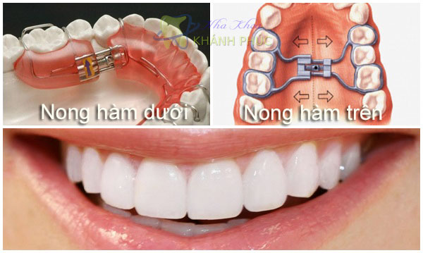 4 câu hỏi khách hàng hay thắc mắc về biện pháp nong hàm trong niềng răng