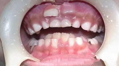 Hàm răng đôi do không kiểm soát quá trình thay răng của bé