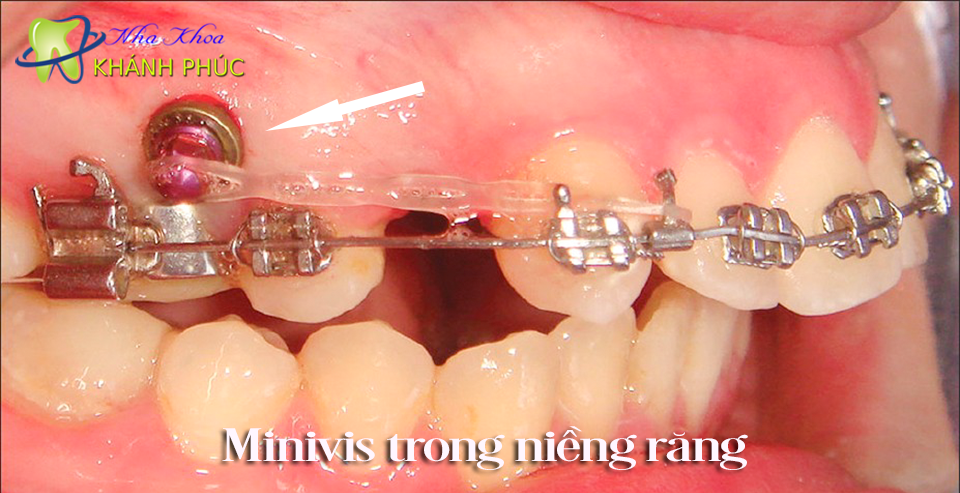 Khi nào cần dùng đến minivis trong niềng răng?
