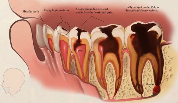 Nhổ răng sâu phòng tránh biến chứng cho vùng răng lân cận