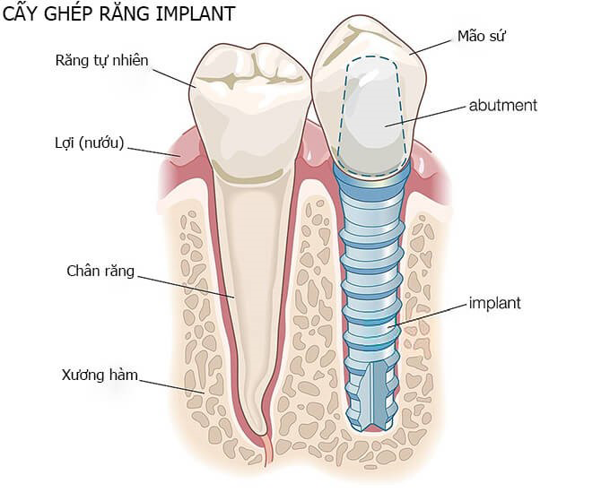 Trồng răng Implant sau khi nhổ răng