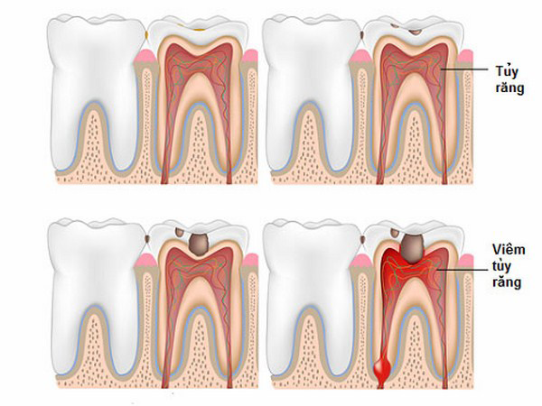 Điều trị viêm tủy răng có an toàn không?