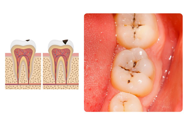 Sâu răng chưa gây đau nhức khi mới ở giai đoạn đầu
