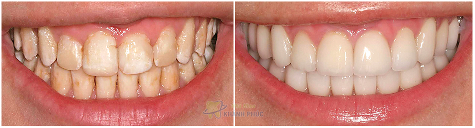 Bạn có đang gặp phải tình trạng thiểu sản men răng?