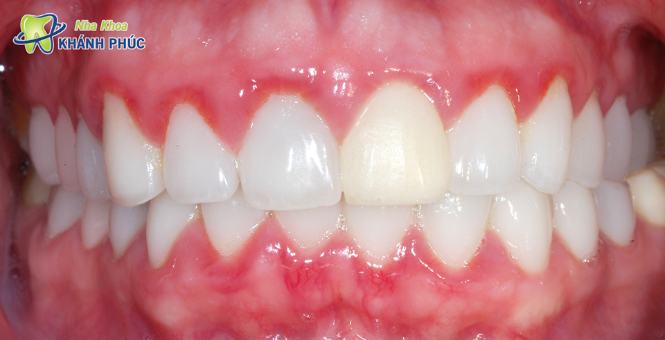 Viêm nướu răng nhận biết như thế nào?