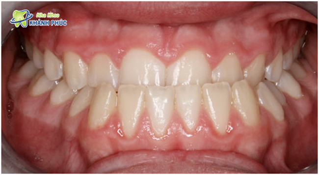 Răng móm gây mất cân đối gương mặt