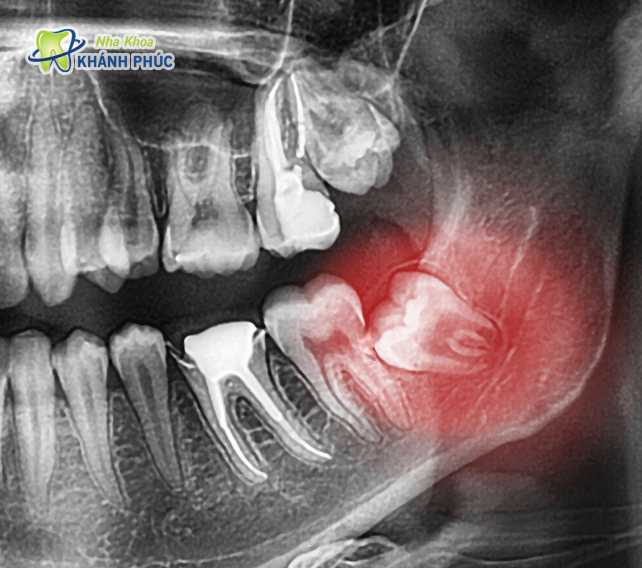 Răng khôn mọc lệch gây ra hư hại trên răng số 7