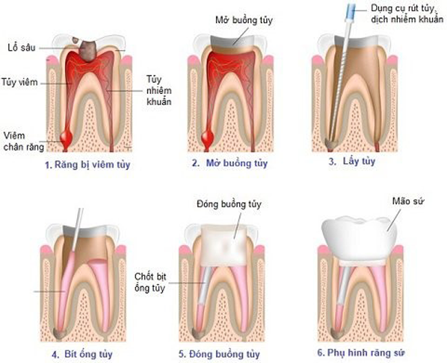 Các bước điều trị tủy răng không hồi phục