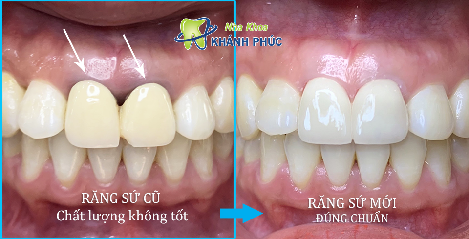 Răng thật chịu ảnh hưởng gì khi chất lượng răng sứ không tốt?
