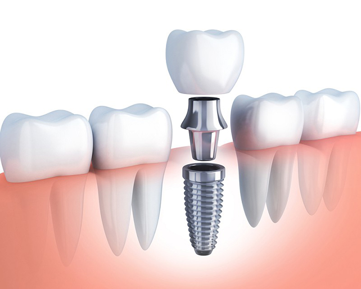 Hậu quả khi trồng răng Implant sai cách?
