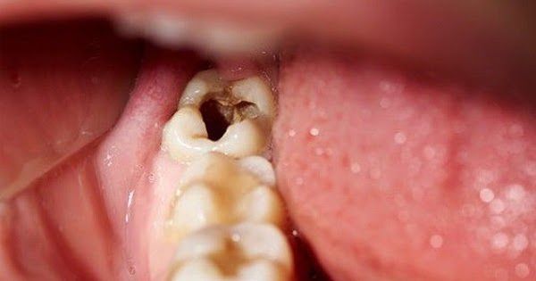 Bệnh về răng miệng luôn là nỗi ám ảnh của nhiều người