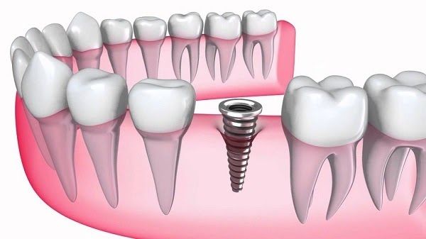 Cấy ghép răng implant đang là xu hướng làm đẹp được nhiều người lựa chọn