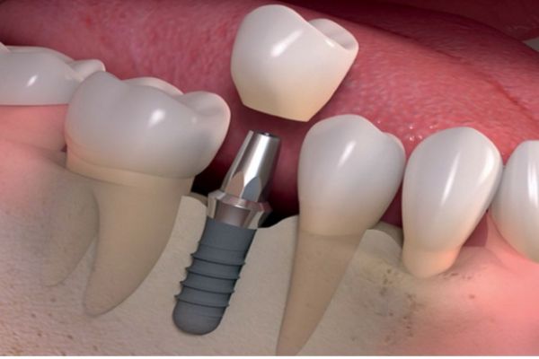 Ưu điểm nổi bật của phương pháp cấy ghép răng implant