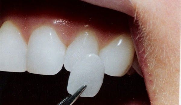 Những yếu tố quyết định độ bền của răng sau khi dán sứ veneer
