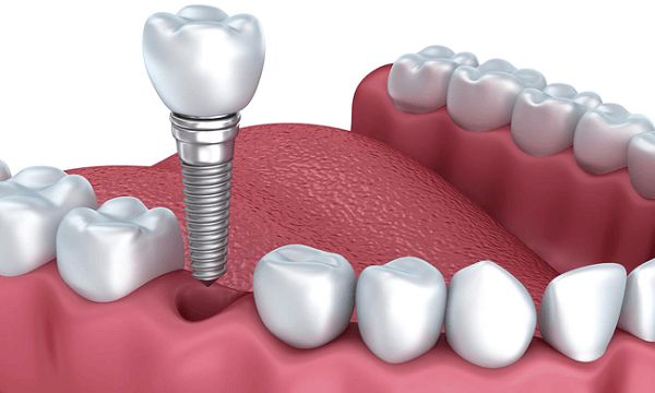Cấy ghép implant giúp khắc phục những nhược điểm về răng miệng