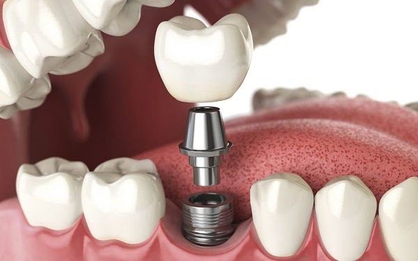 Chăm sóc răng sau khi cấy ghép implant đúng cách