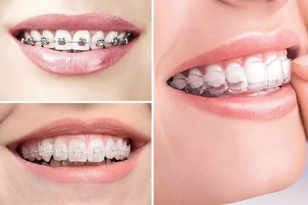 Mức giá niềng răng sẽ phụ thuộc vào nhiều yếu tố như tình trạng răng miệng khách hàng hay địa chỉ nha khoa