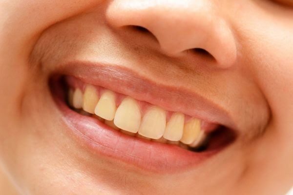 Có rất nhiều nguyên nhân khiến răng bị ố vàng
