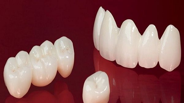 Tham khảo những dòng răng sứ được lựa chọn nhiều nhất hiện nay