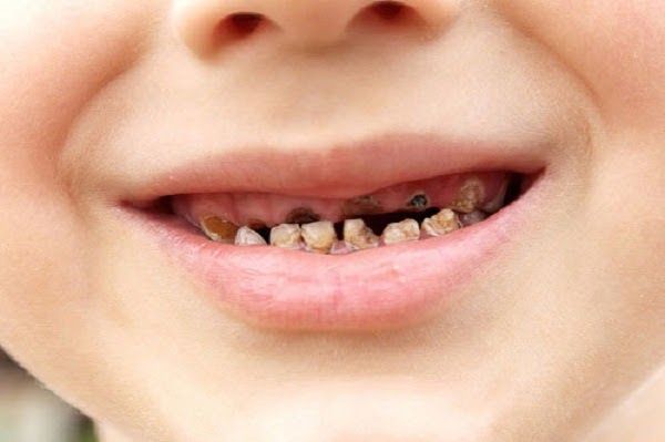 Trẻ nhỏ bị sâu răng là tình trạng khá phổ biến hiện nay