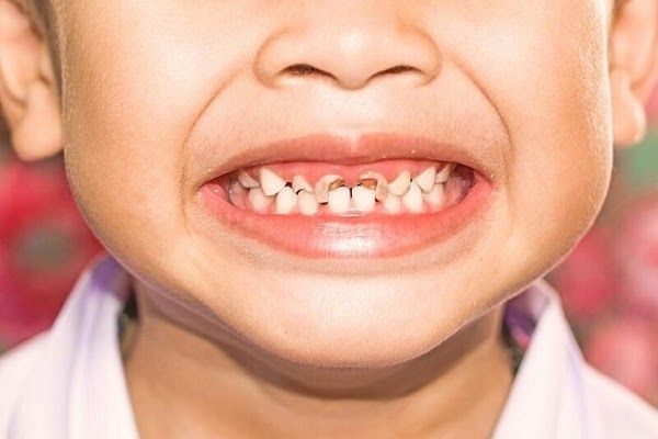 Tìm hiểu những nguyên nhân khiến bé bị sâu răng
