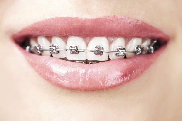 Tùy vào tình trạng mà có thể niềng hay không sau trồng răng Implant