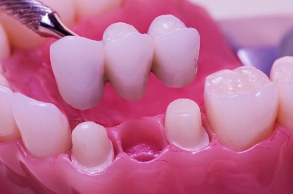 Những điều cần biết khi bọc răng sứ cho trẻ