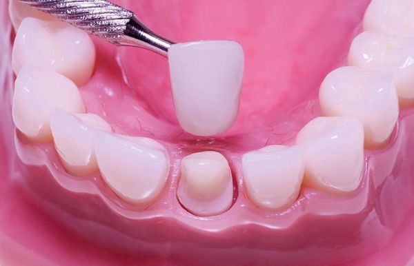 Kỹ thuật bọc răng sứ sở hữu nhiều ưu điểm nổi bật