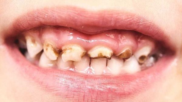 Sâu răng ở trẻ là tình trạng khá phổ biến hiện nay