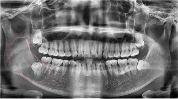 chụp X-quang trước khi nhổ răng khôn