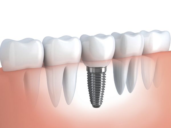Cần thăm khám kỹ càng trước khi cấy răng Implant