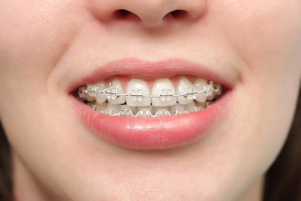 Niềng răng giúp khắc phục những nhược điểm về răng miệng hiệu quả