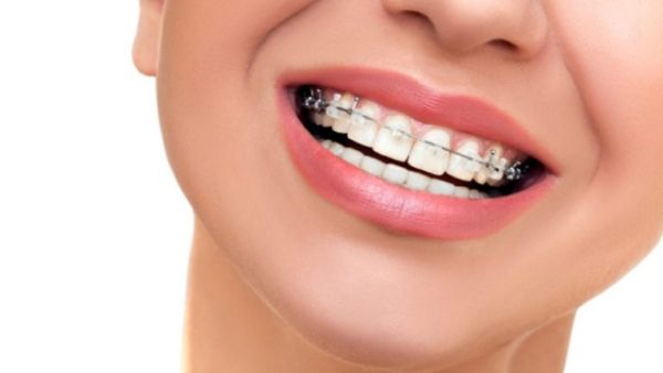 Những điều cần biết về niềng răng 1 hàm