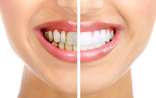 Tẩy trắng răng giúp hàm răng đẹp hơn