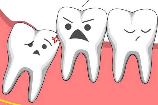 Có nhiều dấu hiệu chứng tỏ răng khôn bị mọc lệch ở hàm trên