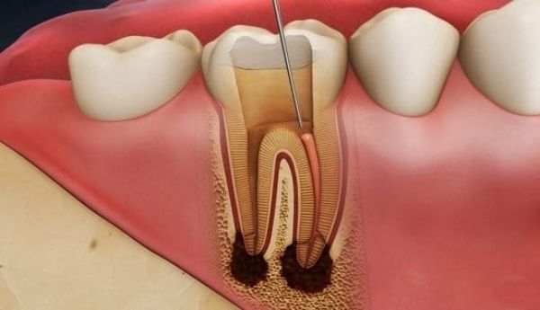 Những điều cần biết về kỹ thuật trám răng lấy tủy