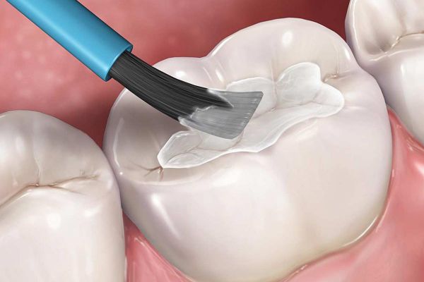 Tham khảo quy trình trám răng lấy tủy chuẩn tại nha khoa Khánh Phúc